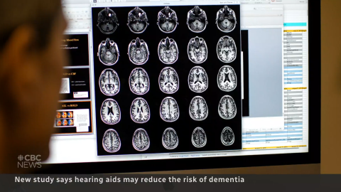 CBC News piece image of brain MRI